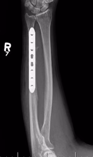 ulna