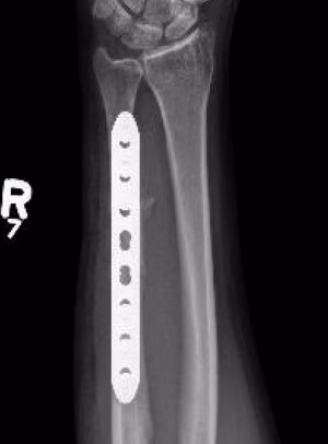 ulna