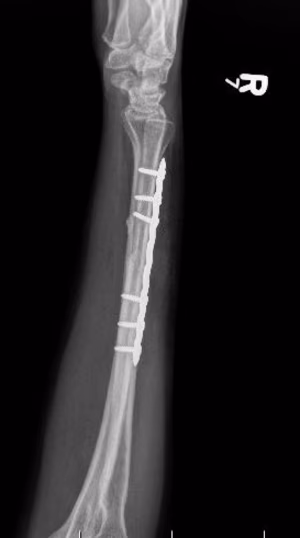 ulna