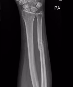 ulna nonunion