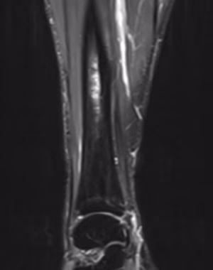 MRI stress