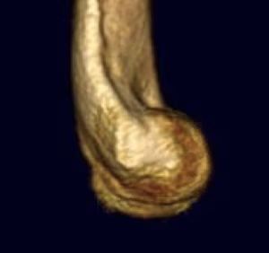 Humerus