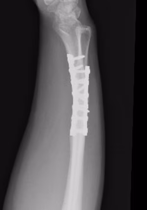 malunion