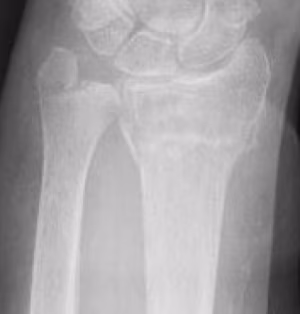 ulna styloid