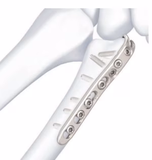 Ulna hook plate