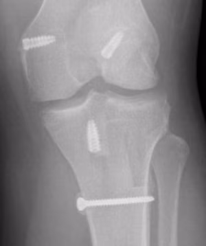 ACL MCL