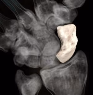 scaphoid