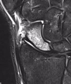 MRI