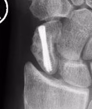 2 screws
