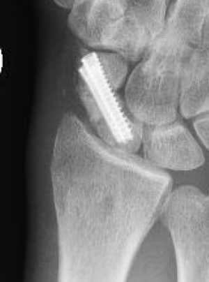 double screw