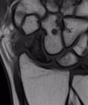 AVN MRI