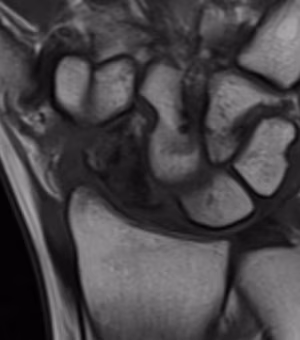 AVN MRI