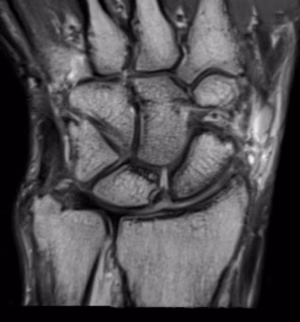 SL mri