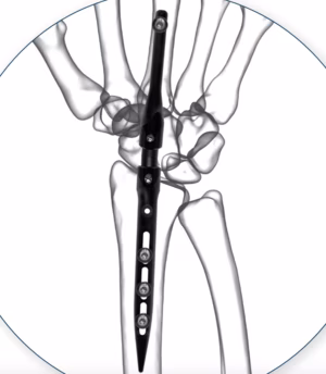wrist nail