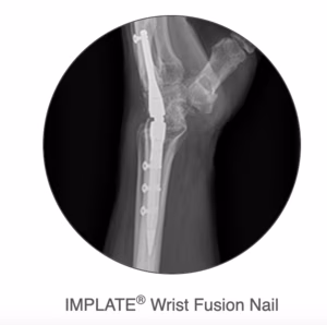 wrist nail