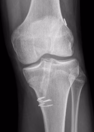 Angular deformity