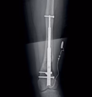 Fitbone