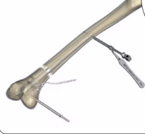 Fitbone femoral nail