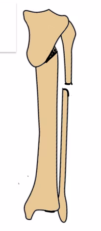 Rab osteotomy