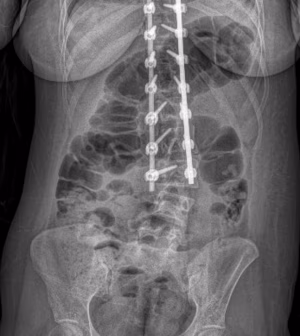 Scoliosis