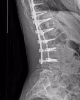 scoliosis