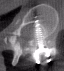 Scoliosis