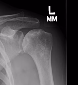 Shoulder AVN