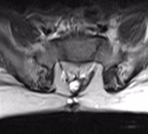 Spina bifida
