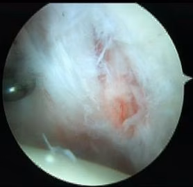 sublabral
