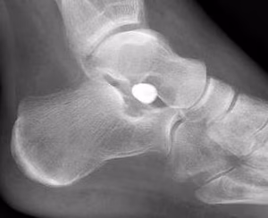 Arthroereisis