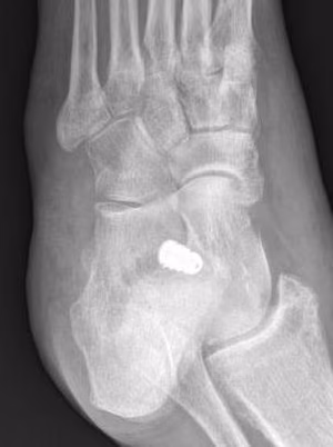 implant