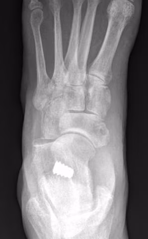 implant