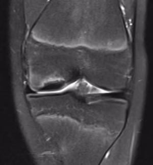 OCD T2 edema pre
