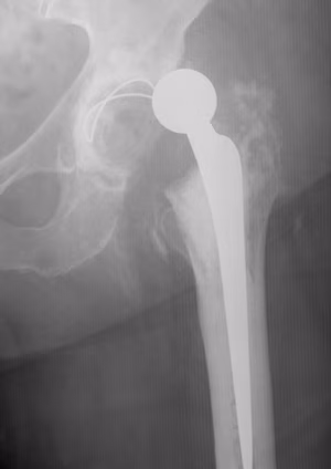 Dislocated dual mobility