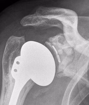 aTSA loose glenoid
