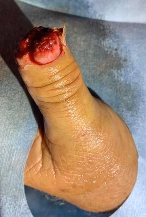 Thumb detip