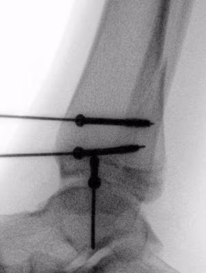 triplanar