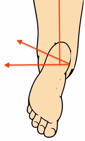 intermalleolar axis