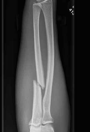 isolated ulna