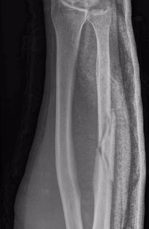 ulna
