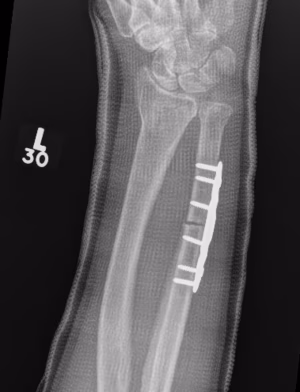 ulna short