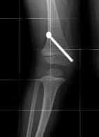 Percutaneous screw