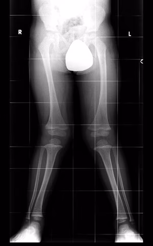 valgus