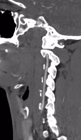 Vertebral artery 3