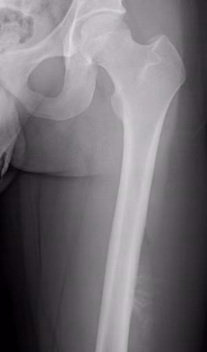 Ewings femur