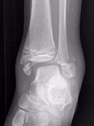 ankle frac