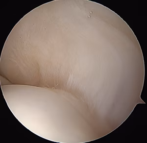 normal cuff
