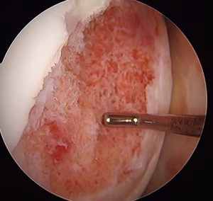 Chondral defect sizing