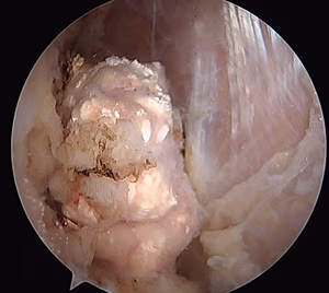 Chondrocalcinosis knee 4