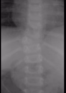 congenital scoliosis